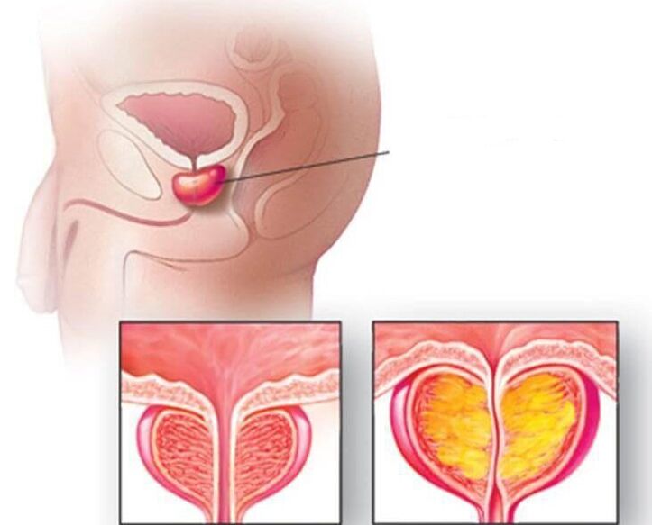 Location of the prostate, normal prostate and enlarged prostate with chronic prostatitis