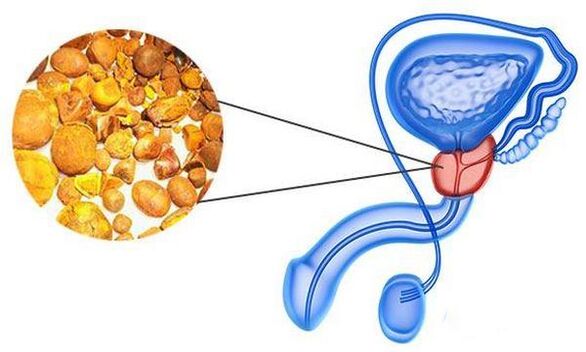 Prostatitis problem