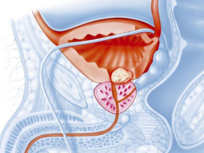 bacterial prostatitis