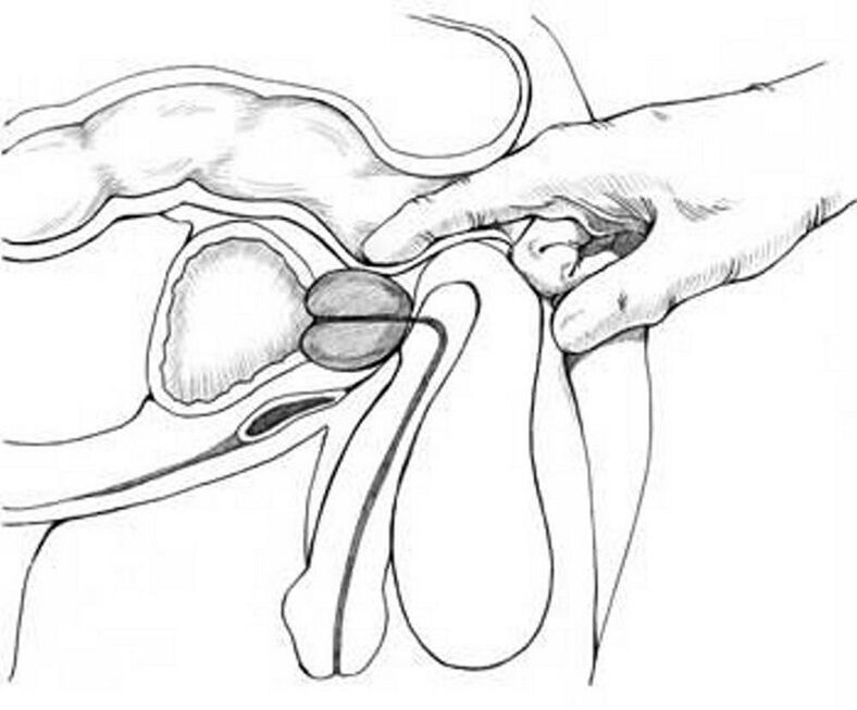 Prostate massage to treat chronic prostatitis