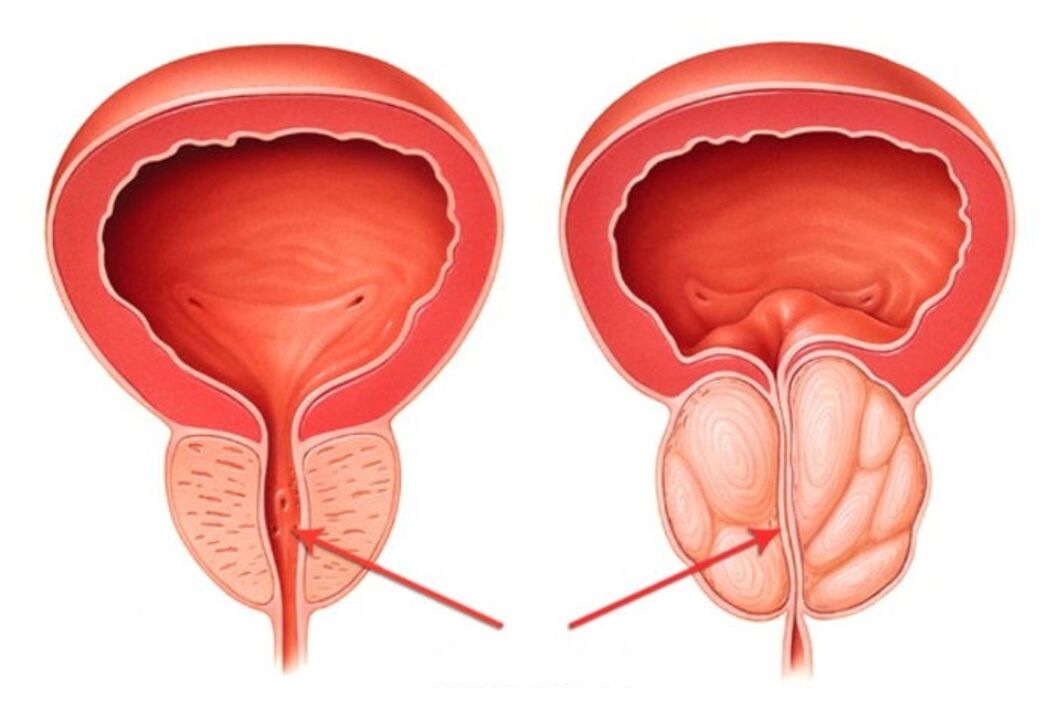 A healthy and inflamed prostate (with prostatitis)
