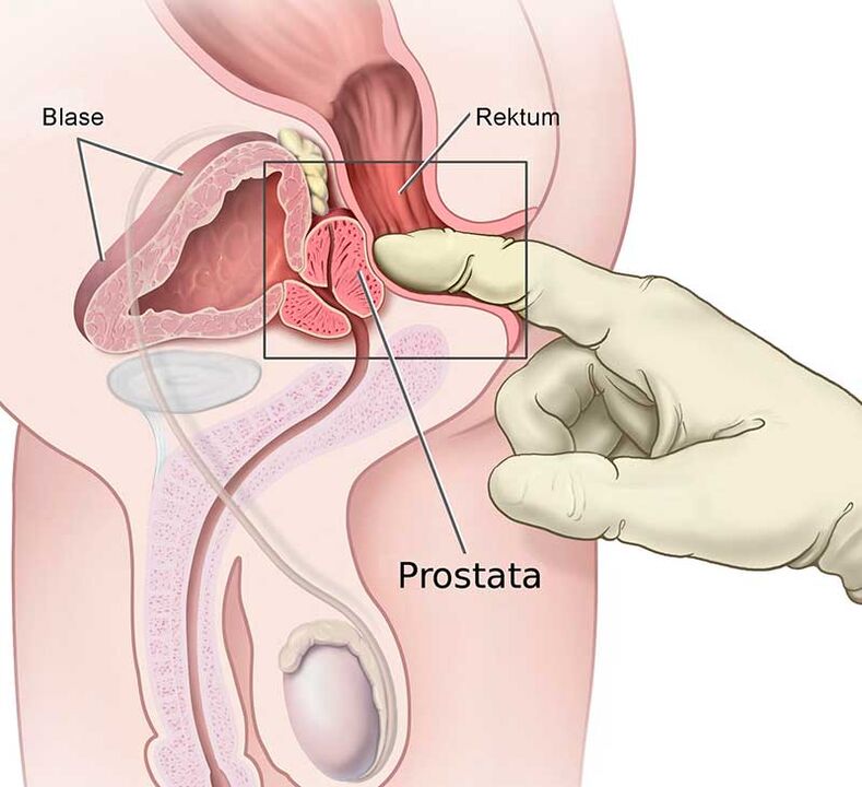 Prostate massage to treat prostatitis
